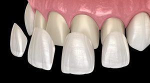 Computerized image of veneers being placed on the upper front teeth