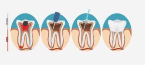 how a root canal is performed