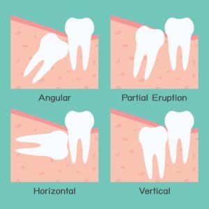Diagram showing different types of wisdom teeth impactions