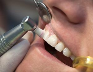 Closeup of a man's teeth being polished with fluoride after a teeth cleaning