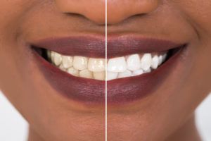Before and after teeth whitening results