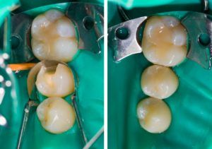 dental crown tooth preparation