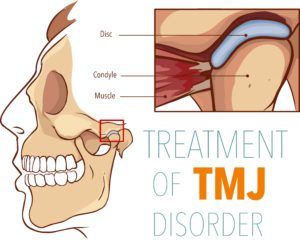 Diagram showing TMJ structures