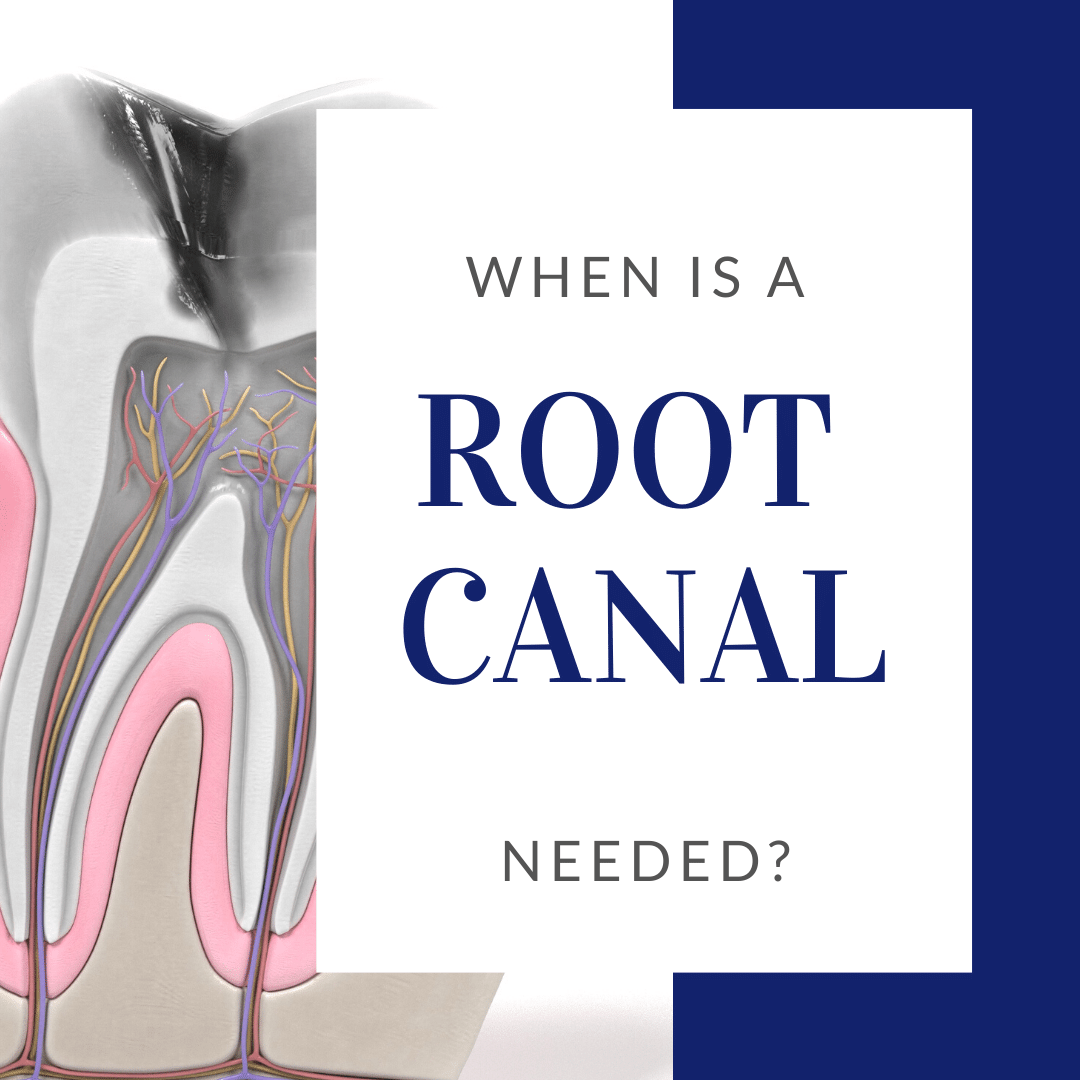 When a Root Canal is Needed? - Ace Dental Care