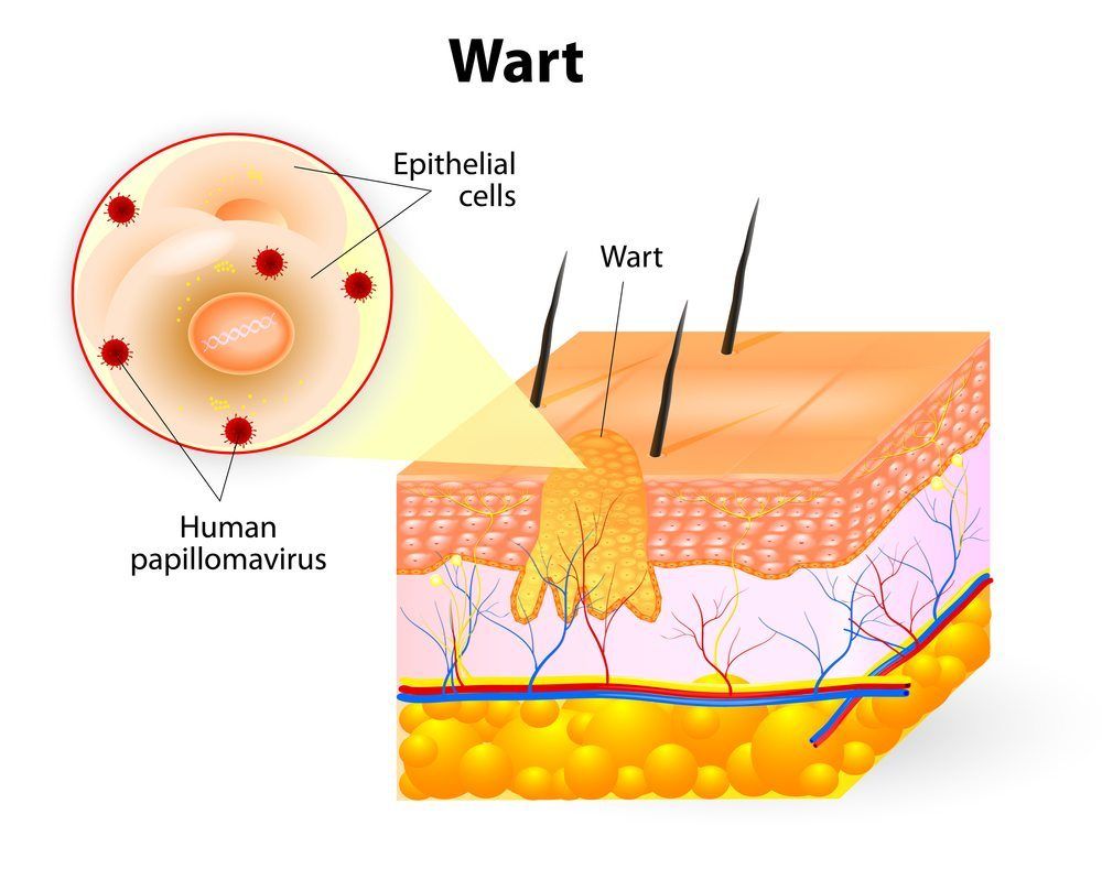 What are the types of hpv that cause genital warts - Hpv warts genital Hpv wart description