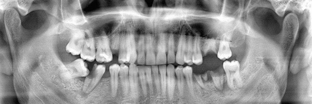 Wisdom Teeth Extraction Corcoran Ca Glo Dental